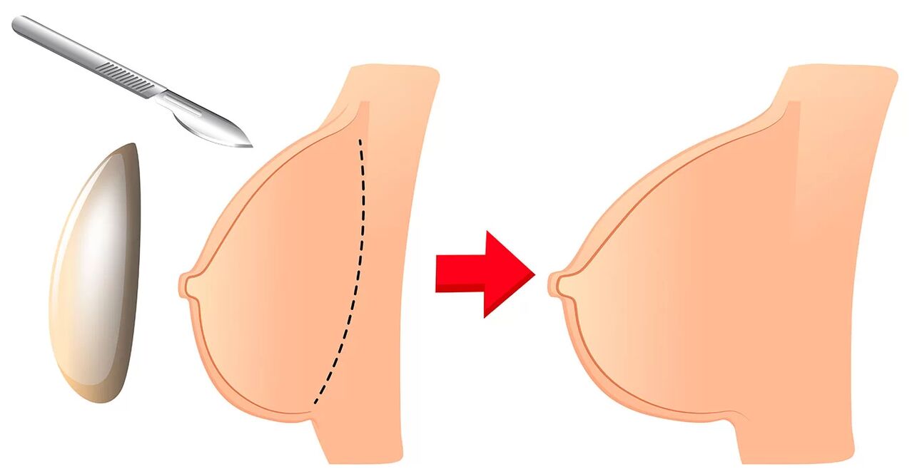 Aumento de senos con implante